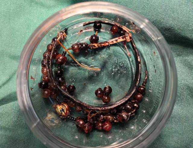 登1信用盘代理
_女子手镯10年没摘竟“长”进肉里登1信用盘代理
！医生：再晚点就保不住了