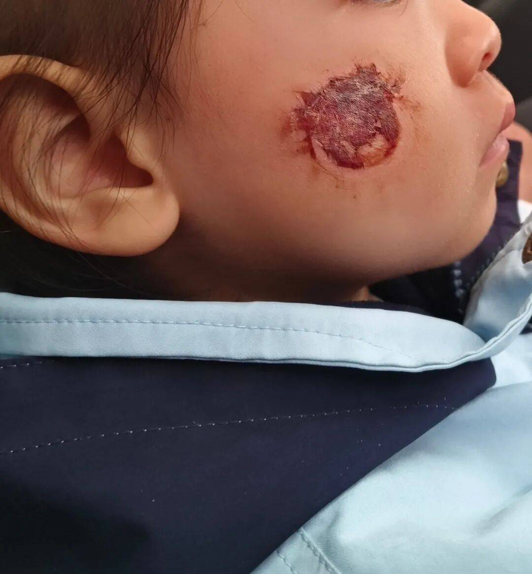 皇冠客服
_3岁女童脸部糜烂皇冠客服
，这东西很多人都在玩！紧急提醒