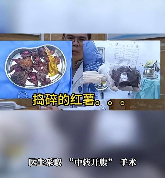 皇冠平台
_61岁男子将17cm红薯塞入肛门皇冠平台
,半夜疼痛难忍被迫就医,医生:尺寸过大,得开腹