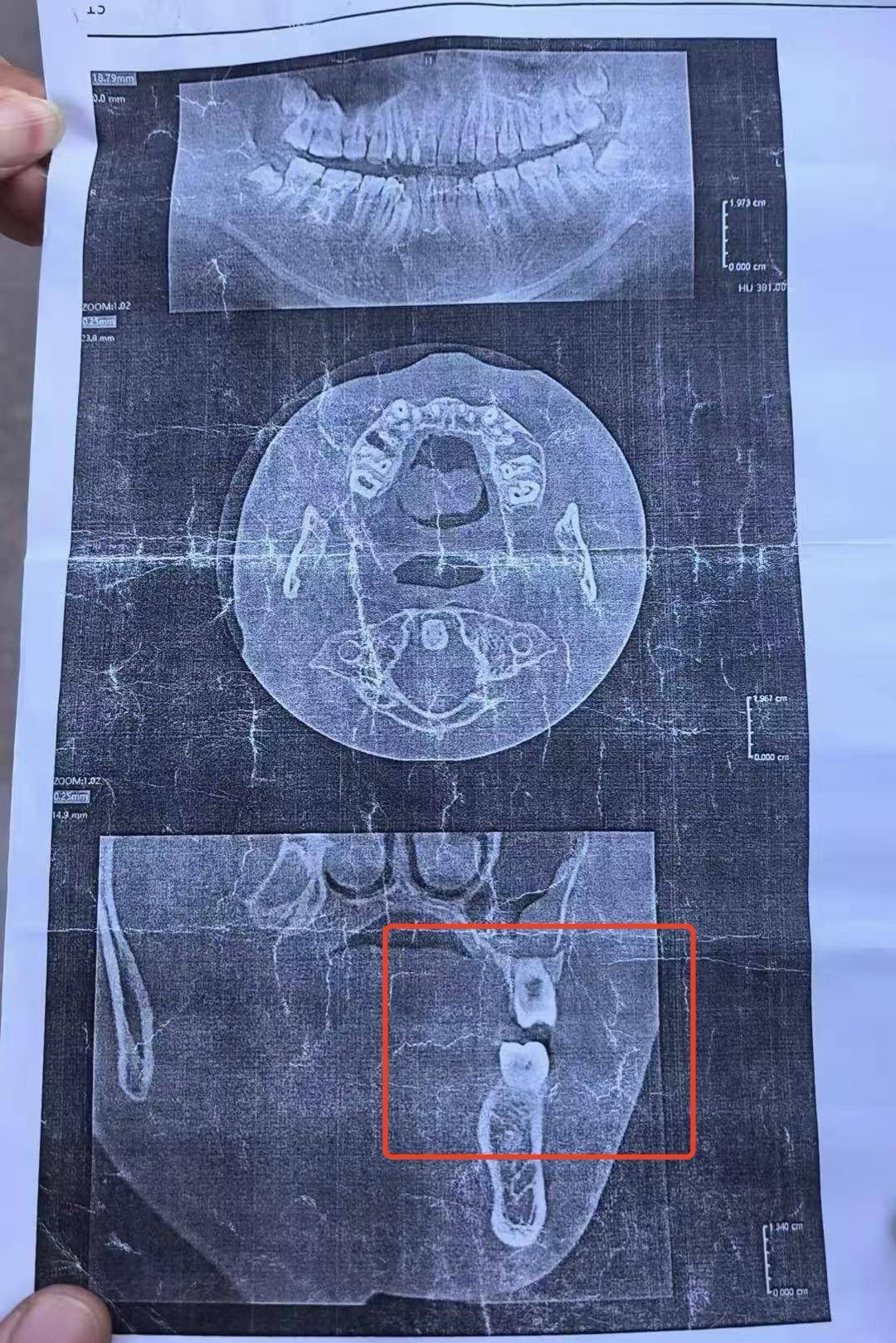 皇冠信用网如何注册_初三男生与体育老师发生冲突面部被打骨折皇冠信用网如何注册,校方:已开除涉事老师,正协商赔偿事宜