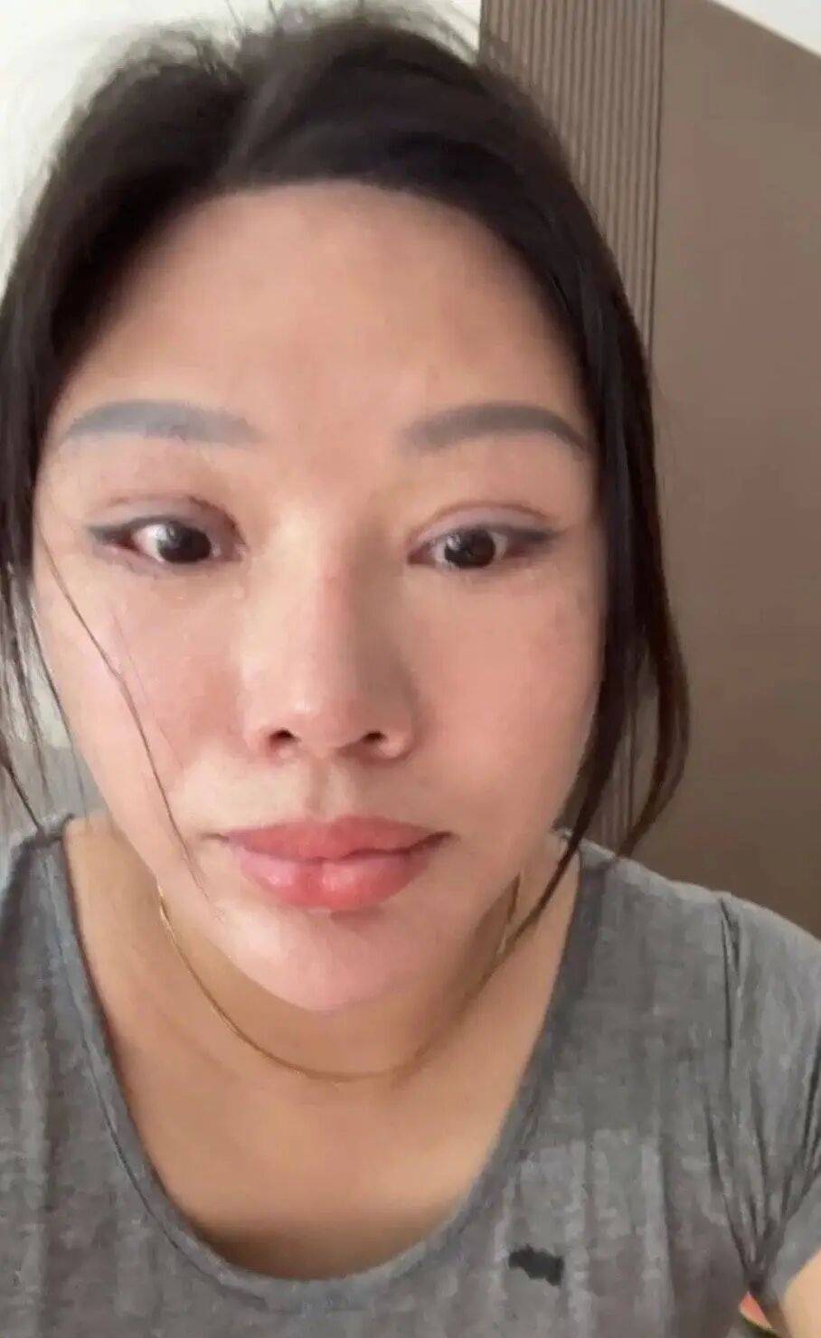 皇冠开户网址_“睡觉都是睁着眼” 皇冠开户网址，女子受老乡邀约，割双眼皮后无法闭眼，落下9级伤残，整形机构老板获刑后反起诉，女子被判退还20万元